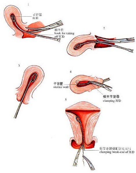 关于上环后半个月能否同房的探讨