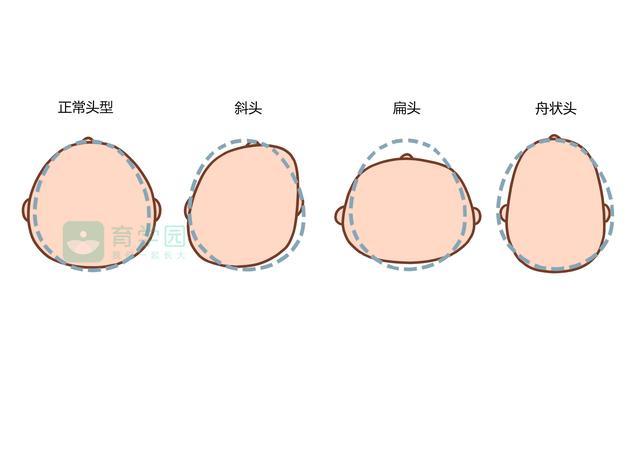 新生儿头型定型的时间节点与成长发育解析